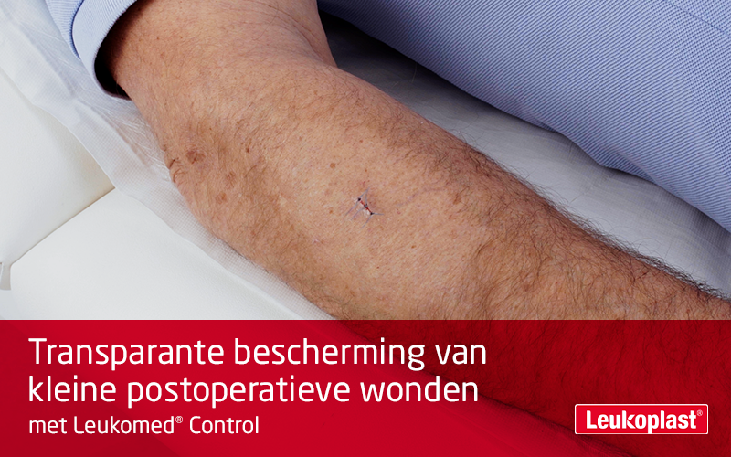 Deze film toont het gebruik van een transparant wondverband: we zien de handen van een zorgprofessional die een kleine chirurgische incisie op de onderarm van een patiënt bedekt met Leukomed Control. Deze film toont het gebruik van een transparant wondverband: we zien de handen van een zorgprofessional die een kleine chirurgische incisie op de onderarm van een patiënt bedekt met Leukomed Control.
